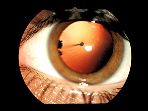 PFV tętnica ciała szklistego